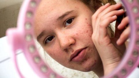 Ein Mädchen mit Akne im Gesicht sieht sich im Spiegel.