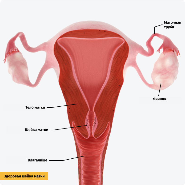 Рак шейки матки. Злокачественные клетки прорастают в окружающие ткани (инвазивная карцинома).