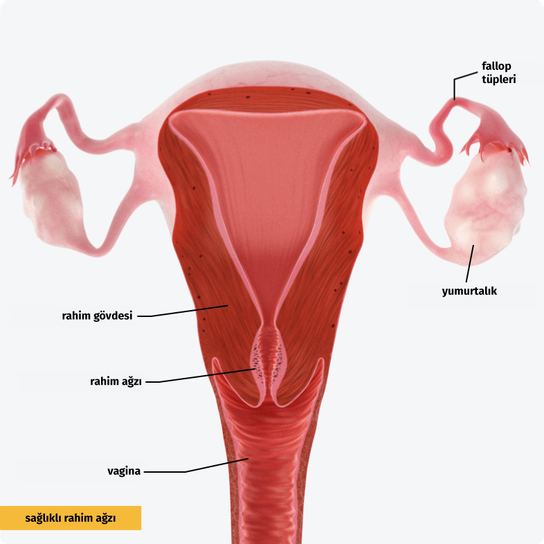 Rahim ağzı kanseri. Malign hücreler çevreleyen dokuya doğru büyür (invaziv karsinom).