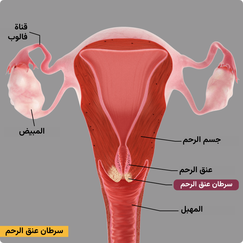 سرطان عنق الرحم. نمو للخلايا الخبيثة في الأنسجة المحيطة (سرطان غازي).