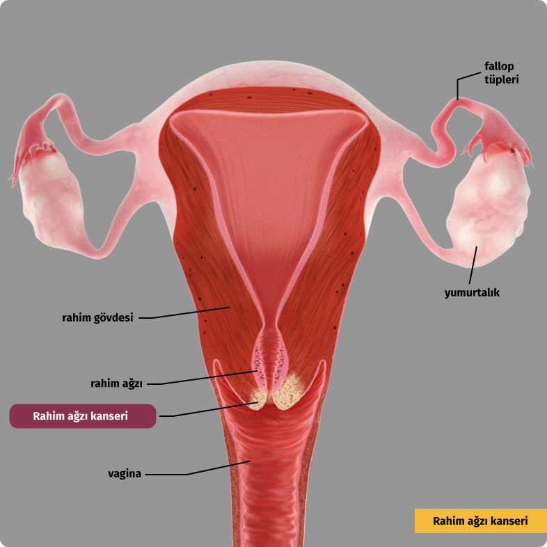 Rahim ağzı kanseri. Malign hücreler çevreleyen dokuya doğru büyür (invaziv karsinom).