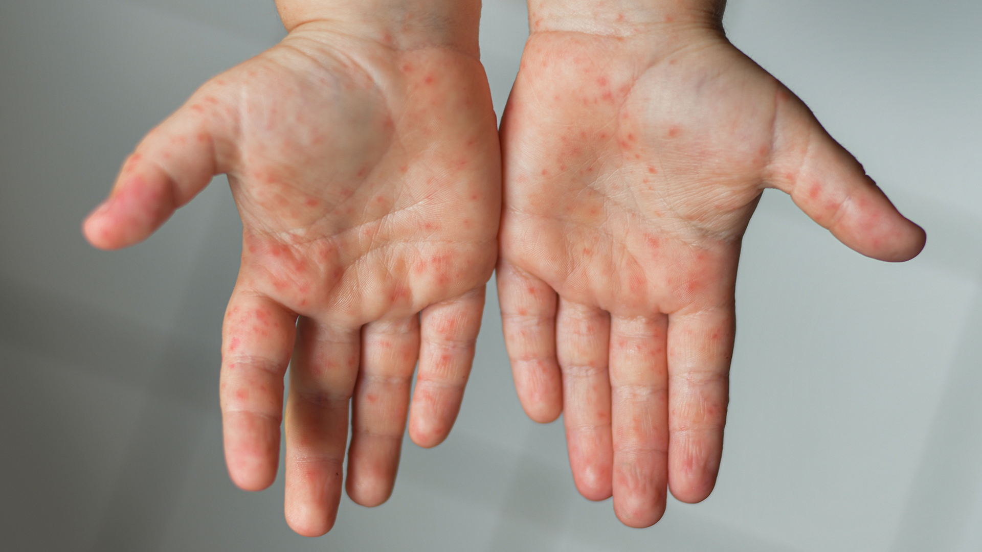 Mund Hand Fuß Krankheit Behandlung