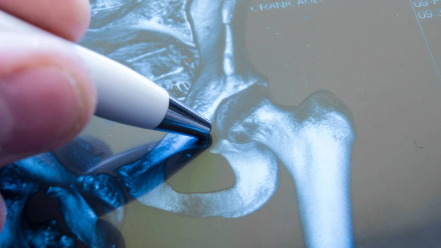 Крупный план снимка бедренной кости и вертлужной впадины