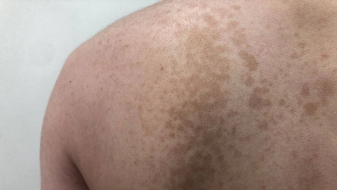 Person mit bräunlichen Hautflecken auf dem Rücken