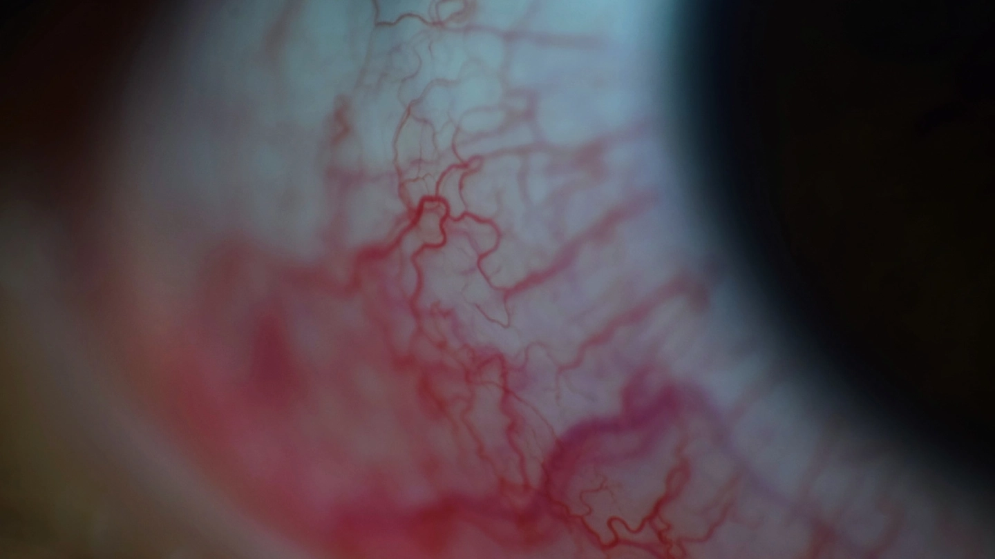 Nahaufnahme eines menschlichen Auges. Zu erkennen sind zahlreiche feine Blutäderchen am Augapfel.