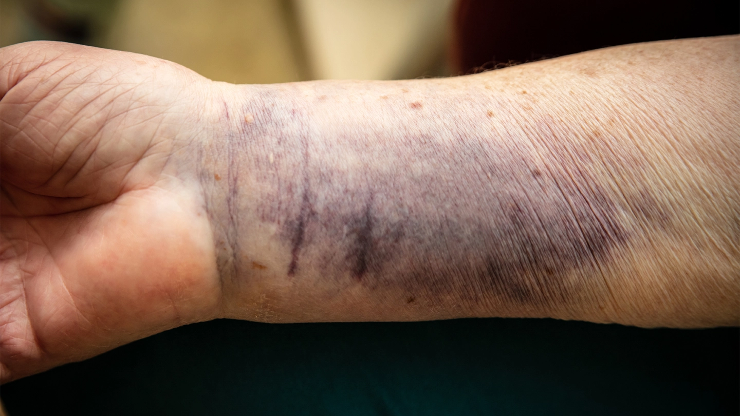 Senile Purpura: Das Handgelenk einer älteren Person weist einen großflächigen blau-violetten Flecken auf.