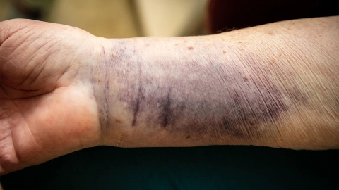 Senile Purpura: Das Handgelenk einer älteren Person weist einen großflächigen blau-violetten Flecken auf.