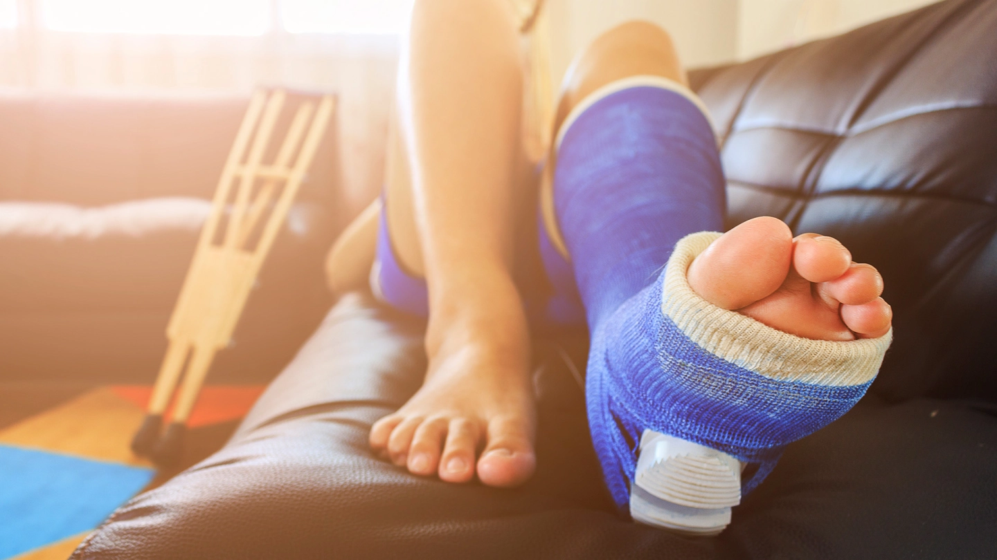 شخص يرتدي جبيرة جبسية في القدم والساق.