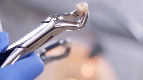 Ein Zahnarzt trägt medizinische Handschuhe und hält eine Zahnzange in der Hand. Am Kopf der Zange, zwischen den Wirkstellen, klemmt ein Weisheitszahn.